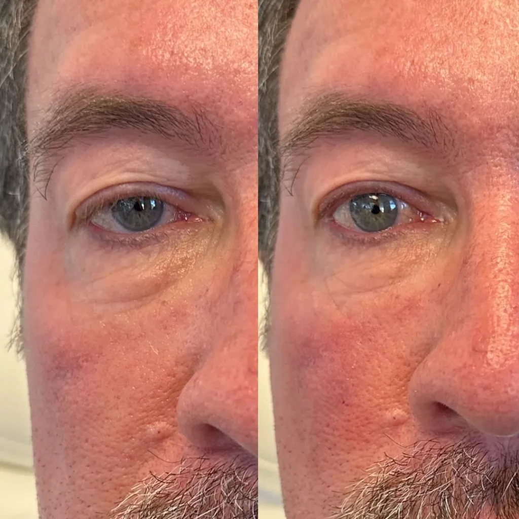 Under Eye Filler at Nuyu Med Spa in Albuquerque, NM