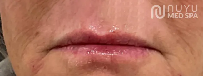 Lip Filler After Treatment At Albuquerque NM Nuyu Medpspa