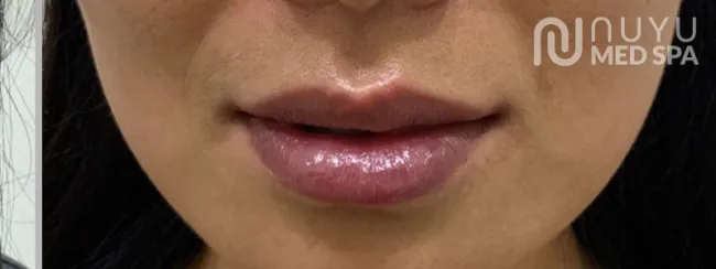 Lip Filler After Treatment At Albuquerque NM Nuyu Medpspa