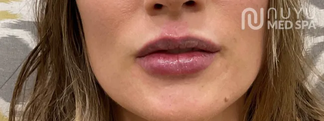 Lip Filler After Treatment At Albuquerque NM Nuyu Medpspa