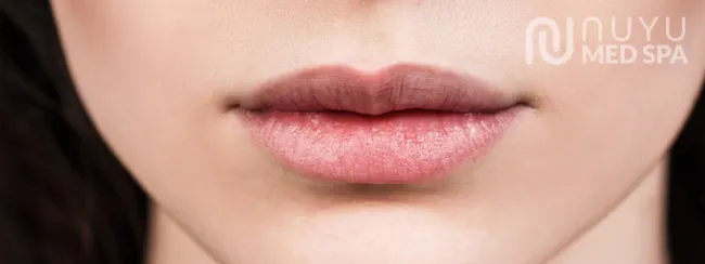 Lip Filler After Treatment At Albuquerque NM Nuyu Medpspa