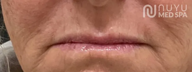 Lip Filler Before Treatment At Albuquerque NM Nuyu Medpspa