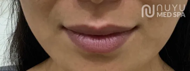 Lip Filler Before Treatment At Albuquerque NM Nuyu Medpspa