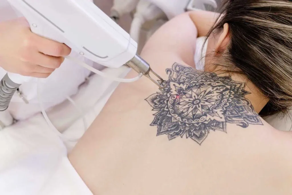 Laser Tattoo Removal at NUYU MedSpa