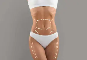 Lipolysis fat reduction treatment at NUYU Medspa