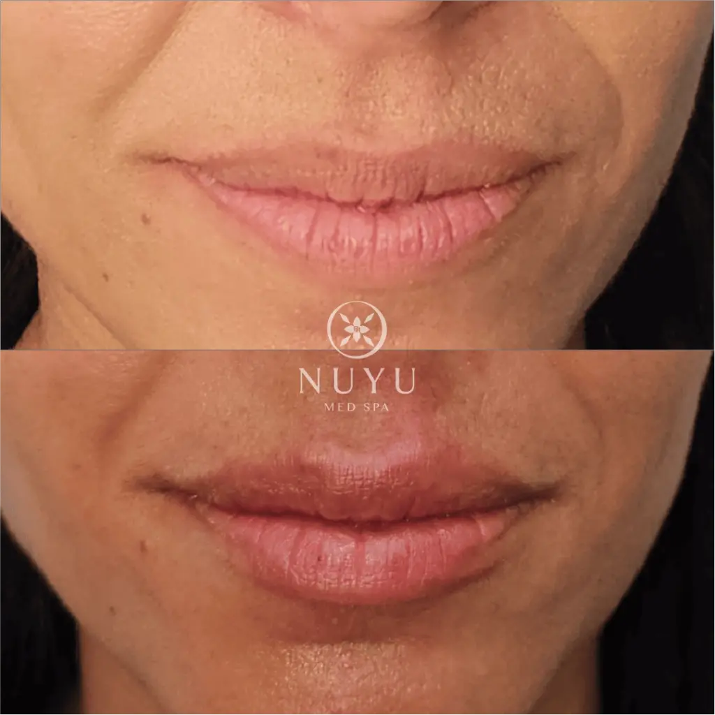 LIP FILLER before & after