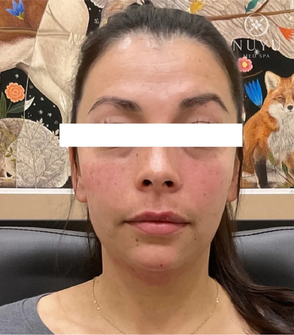 LIP FILLER before & after