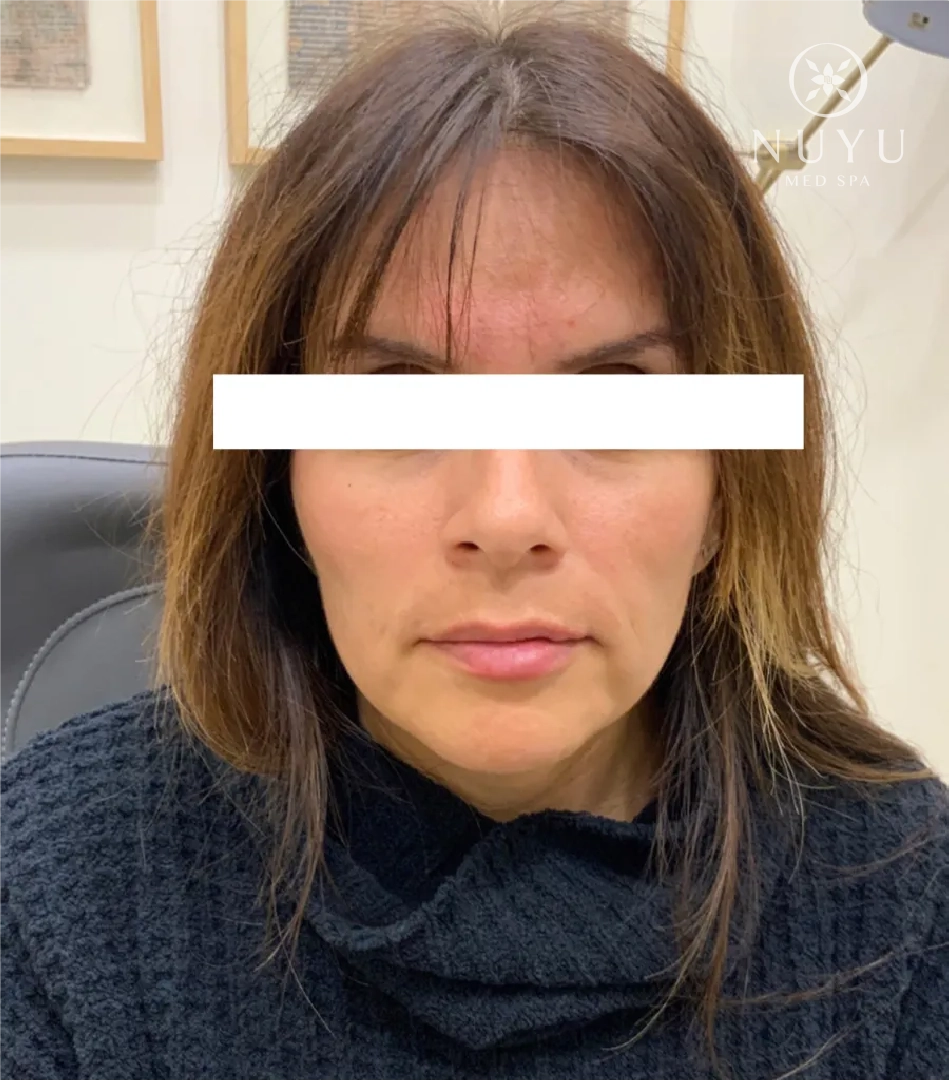 LIP FILLER before & after