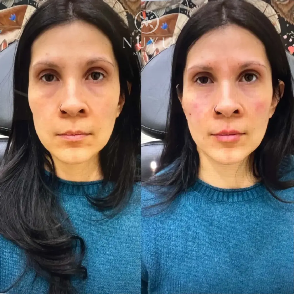 LIP FILLER before & after