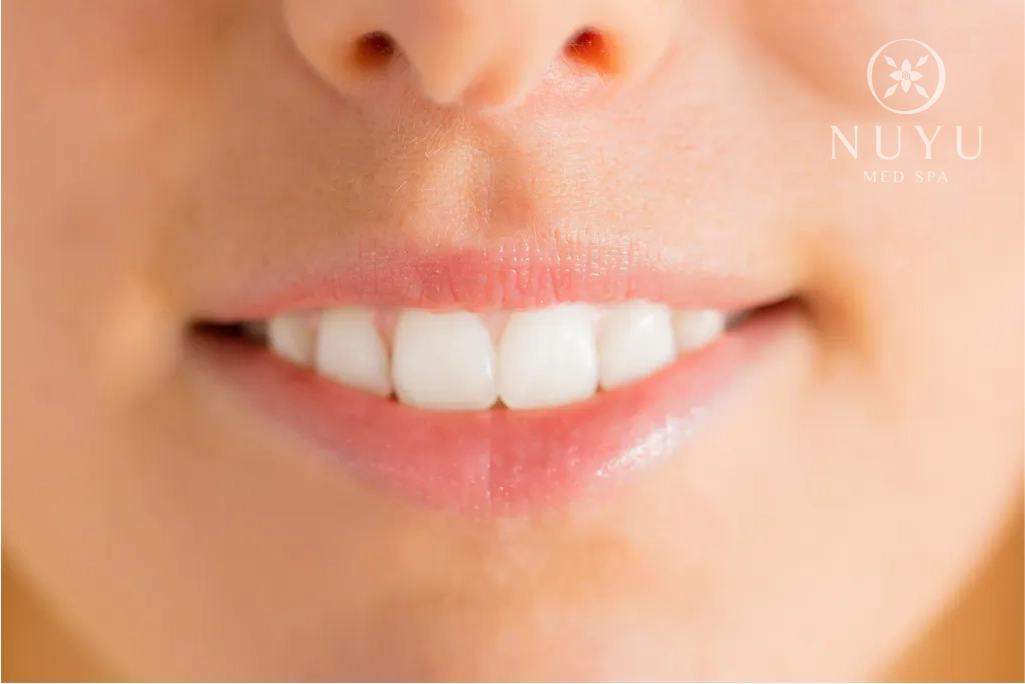 LIP FILLER before & after