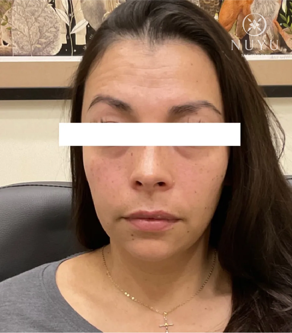 LIP FILLER before & after