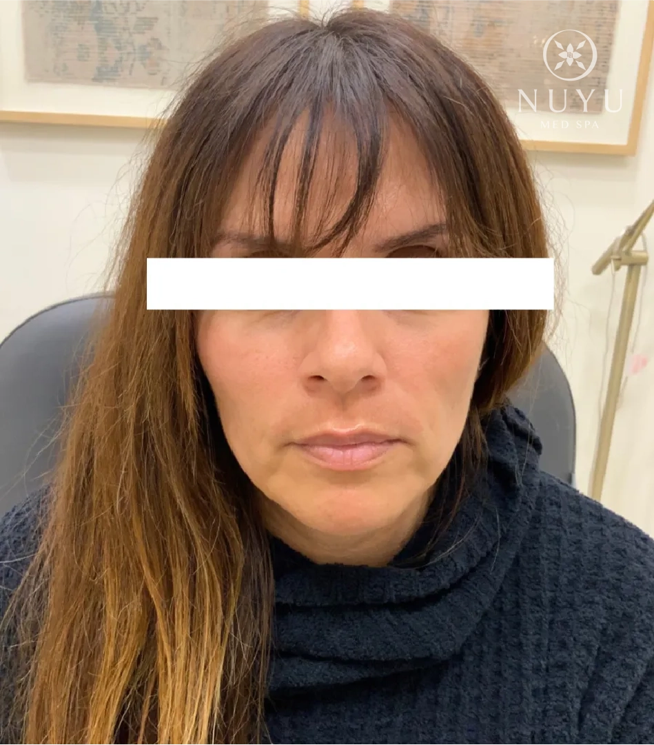 LIP FILLER before & after