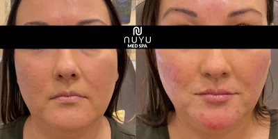 Chin filler by Nuyu MedSpa in Albuquerque, NM